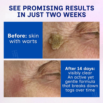 RZXEA™ | Solid-Stick Wart Remover, Skin Tags in Just 48 Hours!