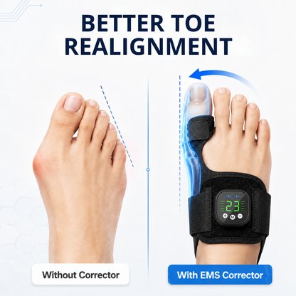 Limited Stock!!! AEXZR® Nexalign Pro — EMS Bunion Corrector