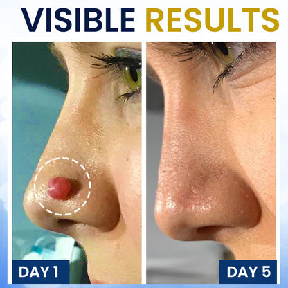 ⚡Instant Removal Power + Clinic-Grade Results🏆AEXZR® Skin Tag Cryo Treatment Spray