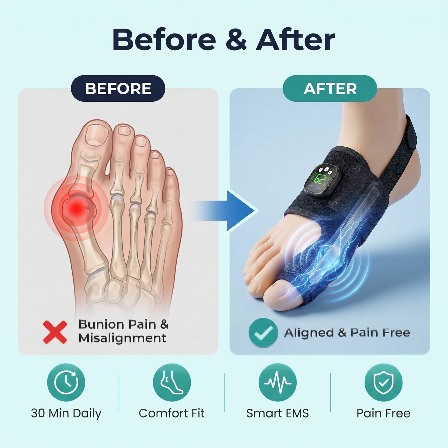 Limited Stock!!! AEXZR® Nexalign Pro — EMS Bunion Corrector