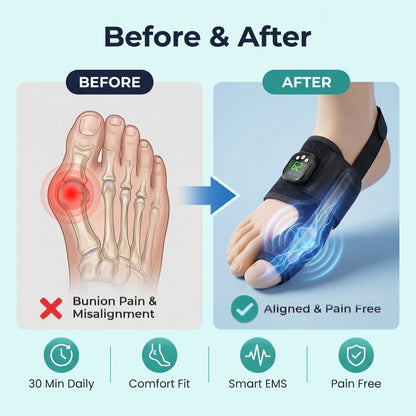 Limited Stock!!! AEXZR® Nexalign Pro — EMS Bunion Corrector
